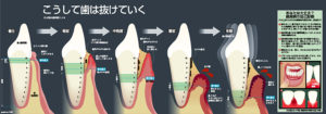 歯周病のメカニズム